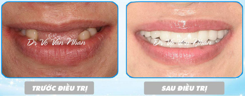 Hình ảnh kết quả trước và sau khi điều trị