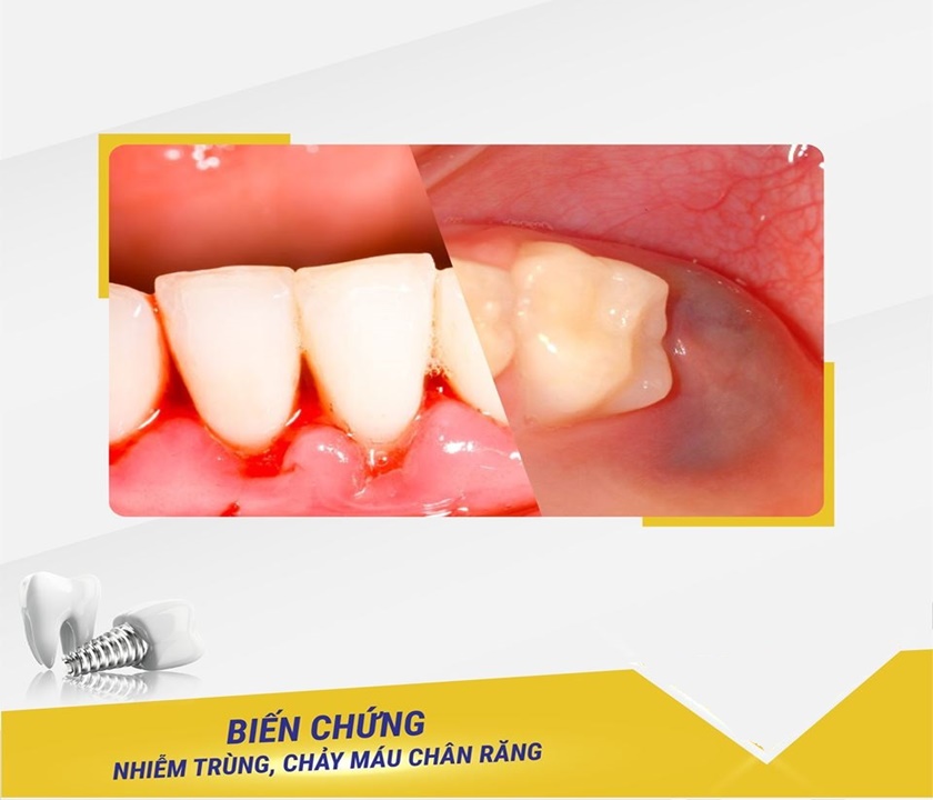 Hiện tượng bị chảy máu kéo dài tại vùng trụ răng sau khi cấy ghép Implant đó chính là biểu hiện của biến chứng thường gặp