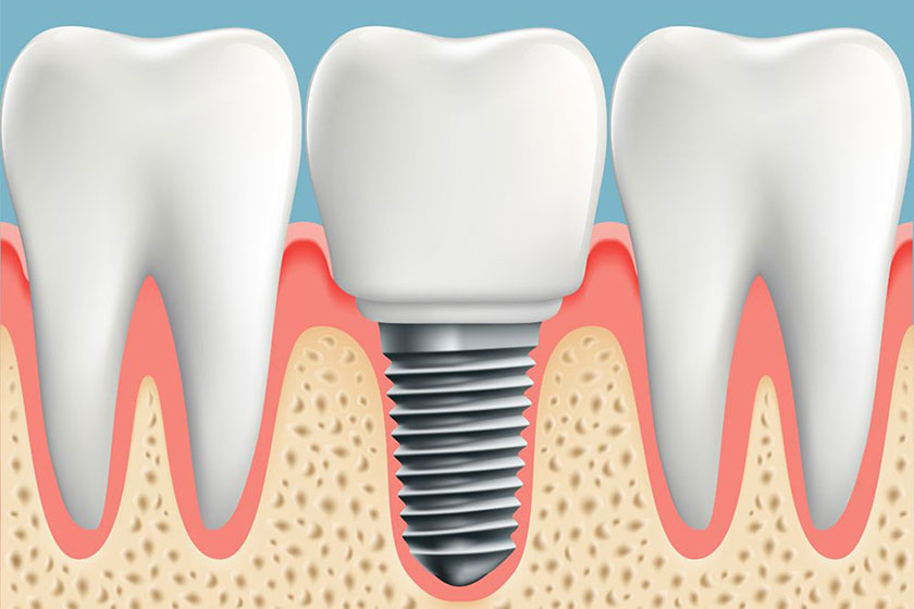 Ưu điểm implant tức thì là giúp bạn rút ngắn thời gian điều trị