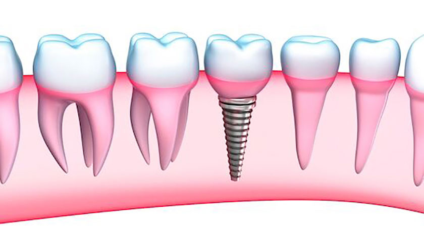 Giá cấy ghép Implant tức thì xứng đáng với chất lượng mà nó đem lại