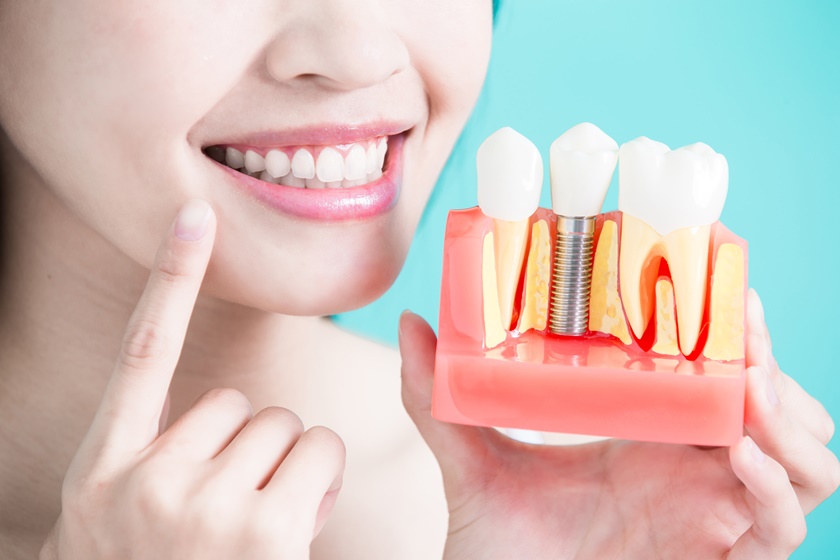 Tùy vào cơ địa mỗi người mà thời gian lành Implant sẽ khác nhau