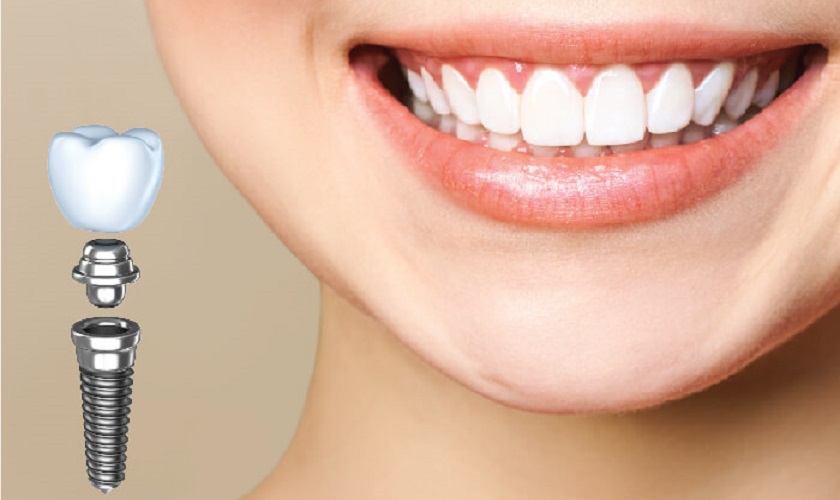 Chuyên gia chia sẻ kinh nghiệm trồng răng Implant mà bạn cần biết