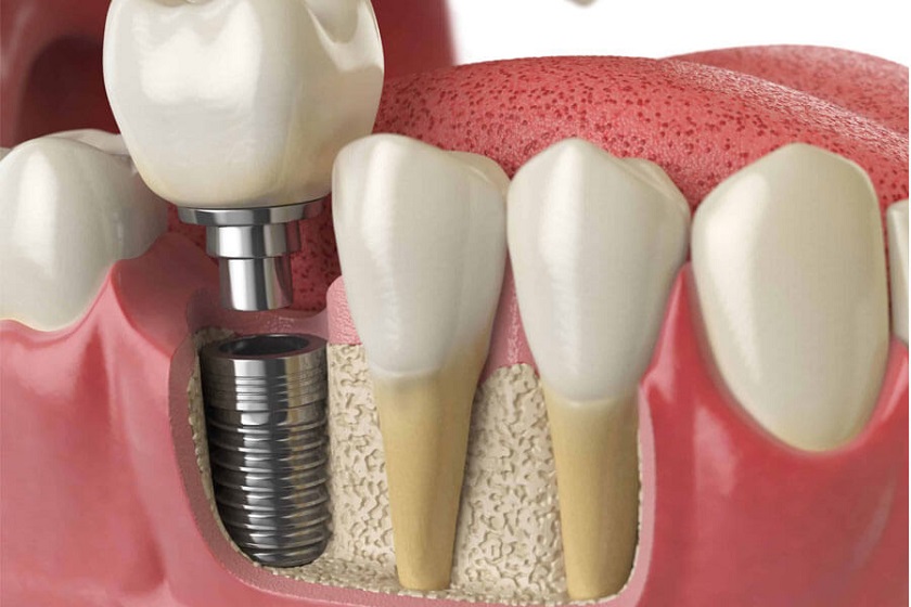 Phương pháp làm răng Implant