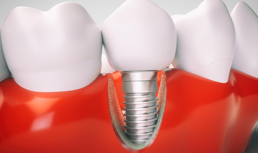 Làm răng implant cần chú ý vấn đề gì?