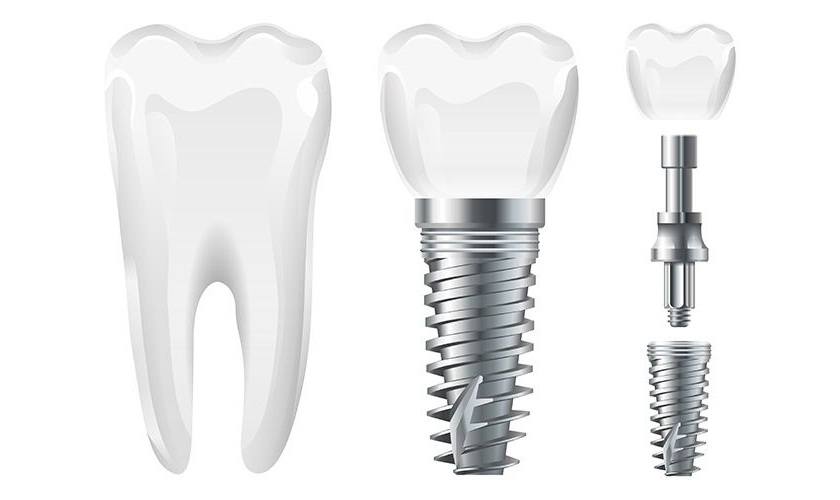 Hiện nay có rất nhiều loại trụ Implant