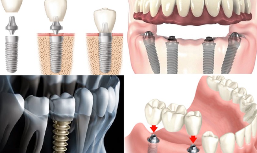Phẫu thuật Implant là giải pháp phục hình răng tối ưu