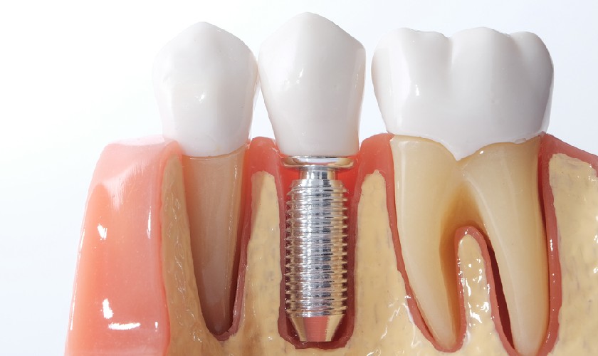 Trụ Implant tích hợp với xương hàm cần một thời gian dài