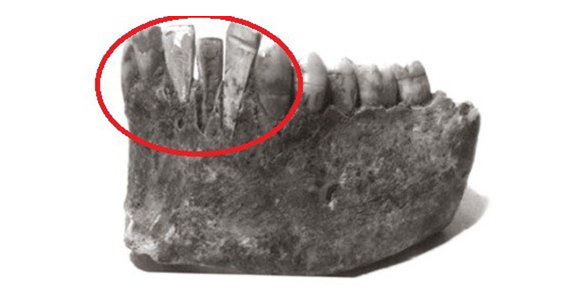 Tài liệu chứng minh người xưa đã biết cách trồng răng giả