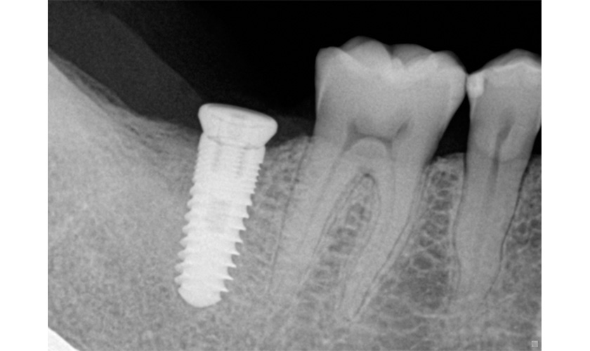 Ca cấy ghép răng Implant đầu tiên tại Việt Nam đến nay vẫn hoạt động tốt