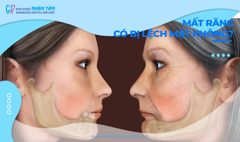 Mất răng có bị lệch mặt không? Nguy cơ & giải pháp khắc phục