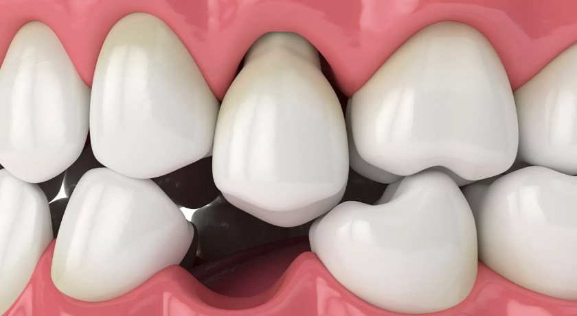 Mất răng khiến hàm răng bị xô lệch Mất răng khiến hàm răng bị xô lệch