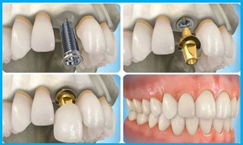Trung tâm nha khoa Nhân Tâm địa chỉ cấy ghép Implant uy tín