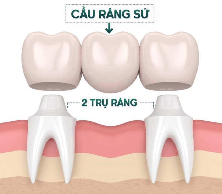 Cầu răng sứ phù hợp với những khách hàng bị mất một hoặc vài chiếc răng