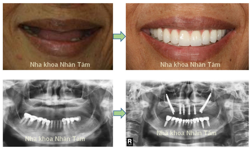 Tỷ lệ cấy ghép Implant thành công rất cao
