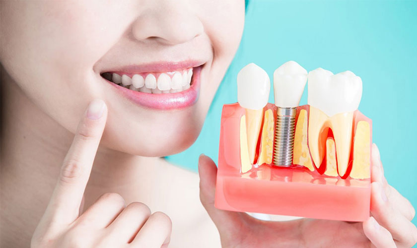 Nha khoa nào triển khai dịch vụ trồng răng Implant trả góp?