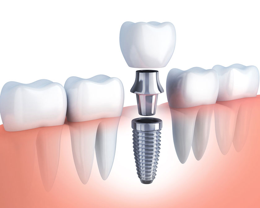 Implant được cấu thành từ kim loại titanium, an toàn với cơ thể