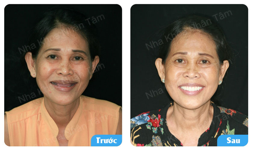 Hình ảnh trước - sau của bệnh nhân