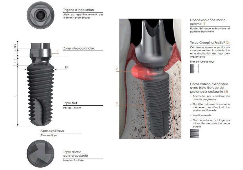 Với thiết kế đặc biệt, Implant Tekka có nhiều ưu điểm vượt trội