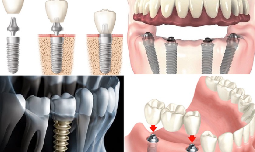 Cấy ghép Implant có ưu điểm vượt trội
