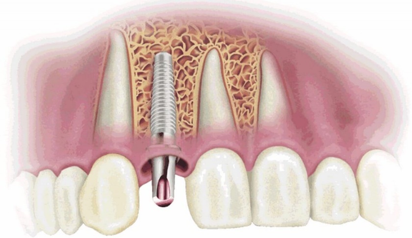 Trồng răng Implant là kỹ thuật phức tạp