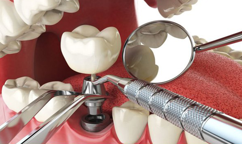 Quy trình cắm Implant đạt chuẩn tại Nha khoa Nhân Tâm