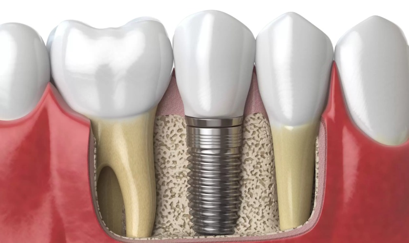 Quy trình trồng răng implant không đau tại Nha khoa Nhân Tâm