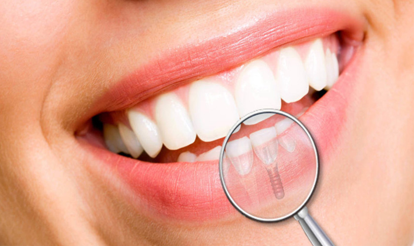 Răng implant mang lại thẩm mỹ vượt trội