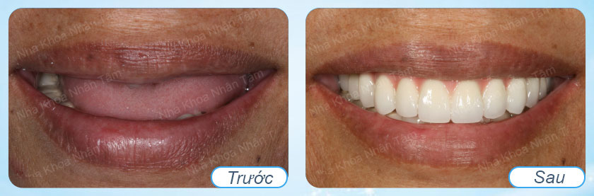 Hình ảnh trước và sau khi trồng răng implant tại nha khoa Nhân Tâm 1