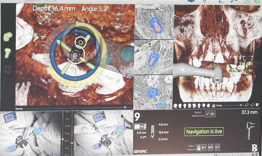 Thông qua hệ thống camera quan sát, Bác sĩ dễ dàng điều hướng mũi khoan đi đúng vị trí Thông qua hệ thống camera quan sát, Bác sĩ dễ dàng điều hướng mũi khoan đi đúng vị trí
