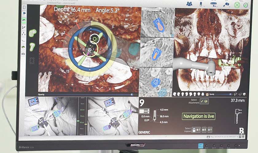 Công nghệ định vị cấy ghép răng Implant giúp Bác sĩ cấy ghép chính xác hơn