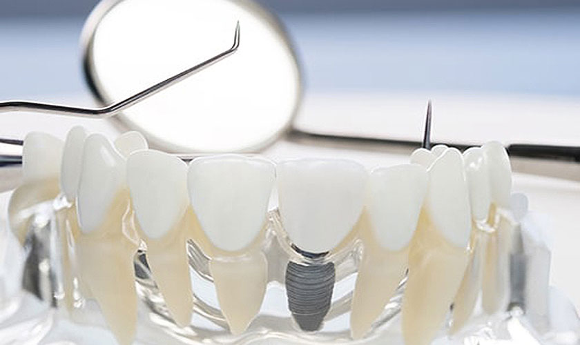 Việc cấy ghép răng Implant có nguy hiểm không khiến nhiều khách hàng đắn đo
