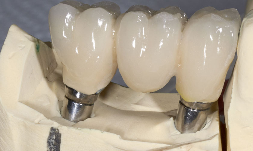 Hãy liên hệ với nha khoa Nhân Tâm để được giá cấy ghép Implant hợp lý nhất