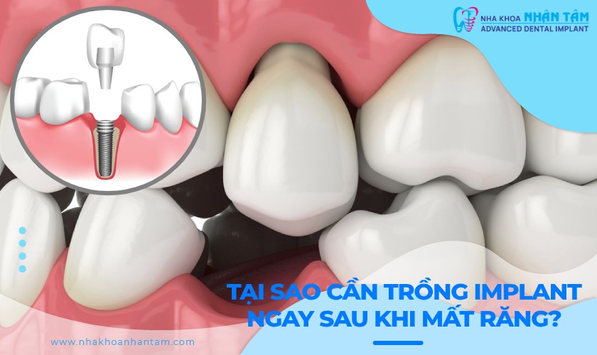 Tại sao cần trồng răng Implant ngay sau khi mất răng?