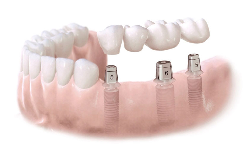 Xác định số lượng, vị trí cần cấy ghép Implant rất quan trọng