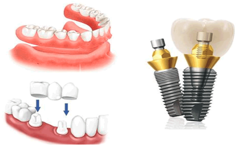 Rất nhiều người có nhu cầu sử dụng cấy ghép răng Implant