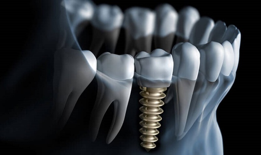 Bật mí trồng răng Implant bao nhiêu tiền cho một liệu trình