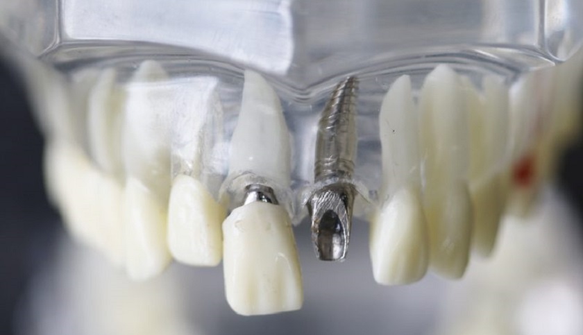 Đặt trụ Implant là thao tác quan trọng trong các bước trồng răng Implant