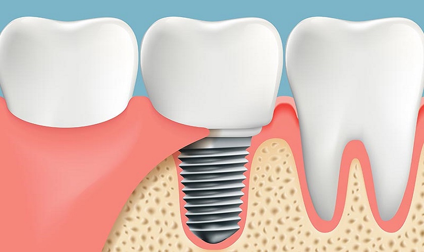 Tìm hiểu các bước trồng răng Implant cơ bản