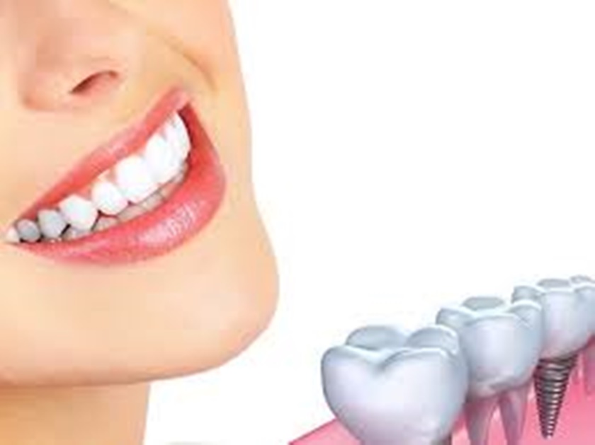 Răng Implant đáp ứng tốt nhu cầu thẩm mỹ