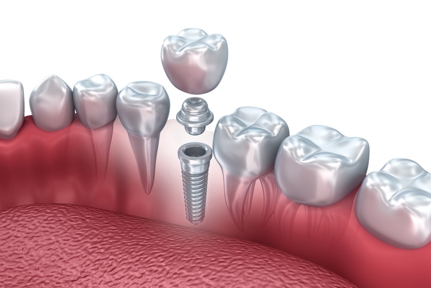Hình ảnh Răng Implant