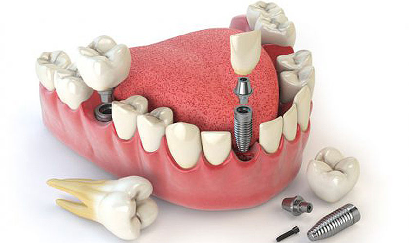 Nhược điểm Implant nha khoa đó chính là chi phí cao