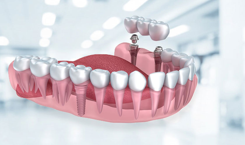 Hãy liên hệ với nha khoa Nhân Tâm khi bạn có nhu cầu trồng răng implant uy tín giá tốt
