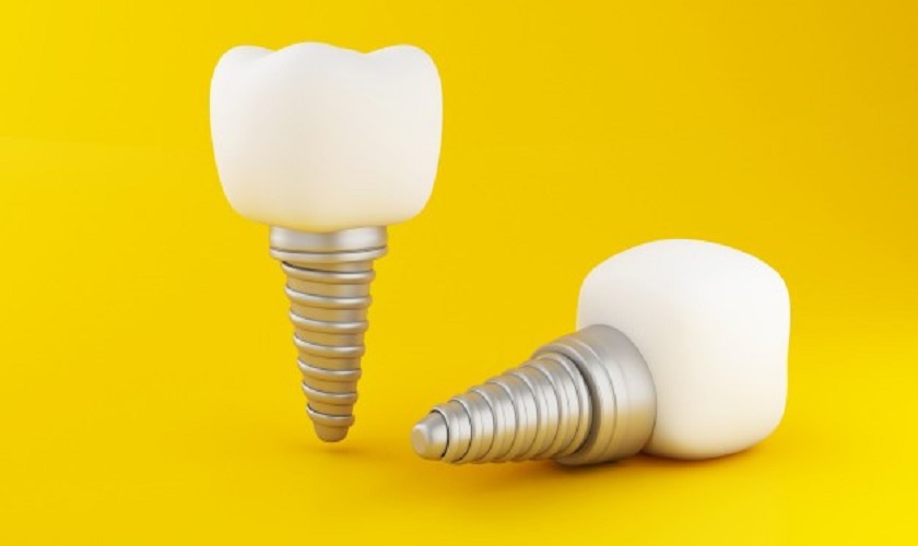 Trụ Implant tích hợp xương nhanh giúp khách hàng rút ngắn thời gian điều trị
