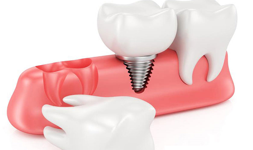 Quy trình cấy ghép Implant cho răng quan trọng ở bước cấy trụ Implant