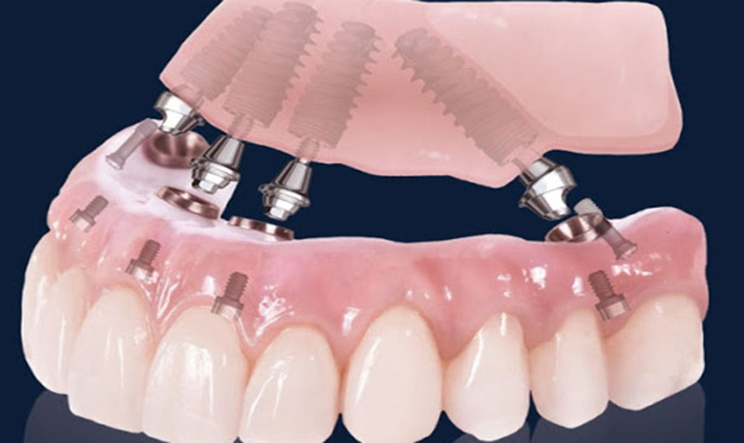 Giá cả cấy ghép Implant Tekka hiện nay tại nha khoa Nhân Tâm từ 20.000.000 – 25.000.000 VNĐ
