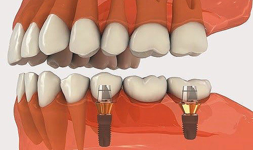 Quy trình cấy ghép implant tức thì để thực hiện được cần phải có bác sĩ giàu kinh nghiệm