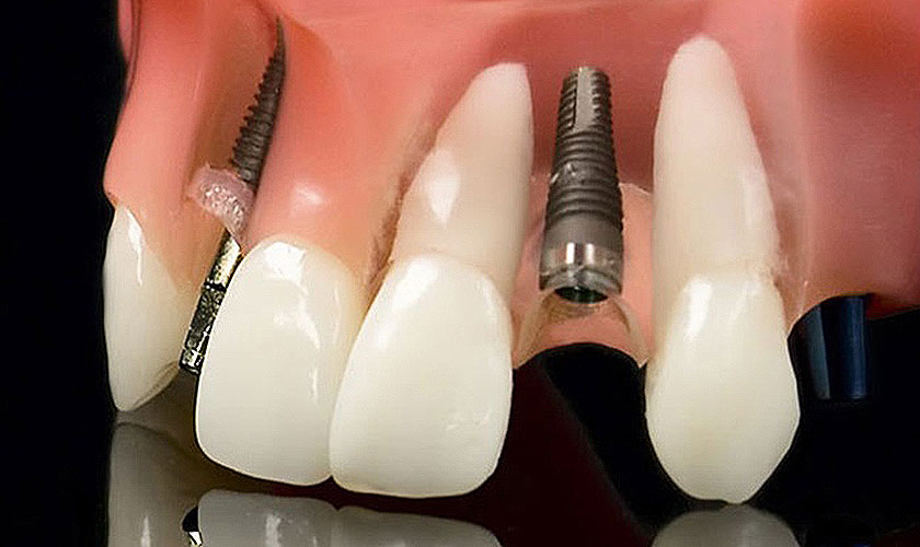 Giá cấy răng Implant tức thì bao gồm chi phí nhổ răng hư và chi phí cấy răng implant tức thì