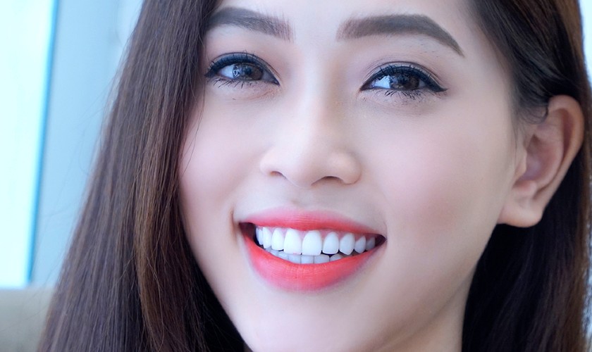 Tìm hiểu ưu nhược điểm và quy trình làm răng Implant Nobel