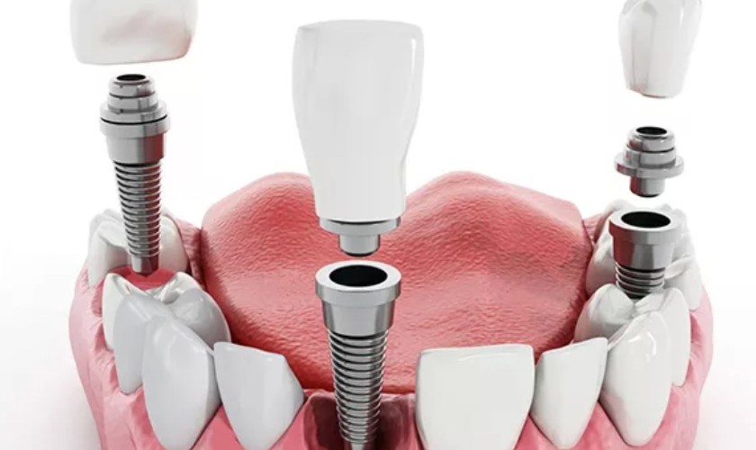 Trồng răng Implant Nobel tại nha khoa Nhân Tâm