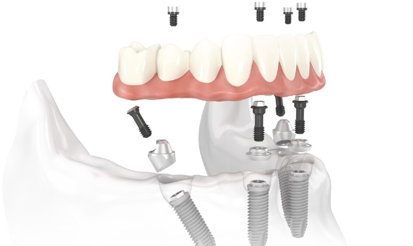 Cấy ghép Implant Nobel có nhiều ưu điểm nổi bật